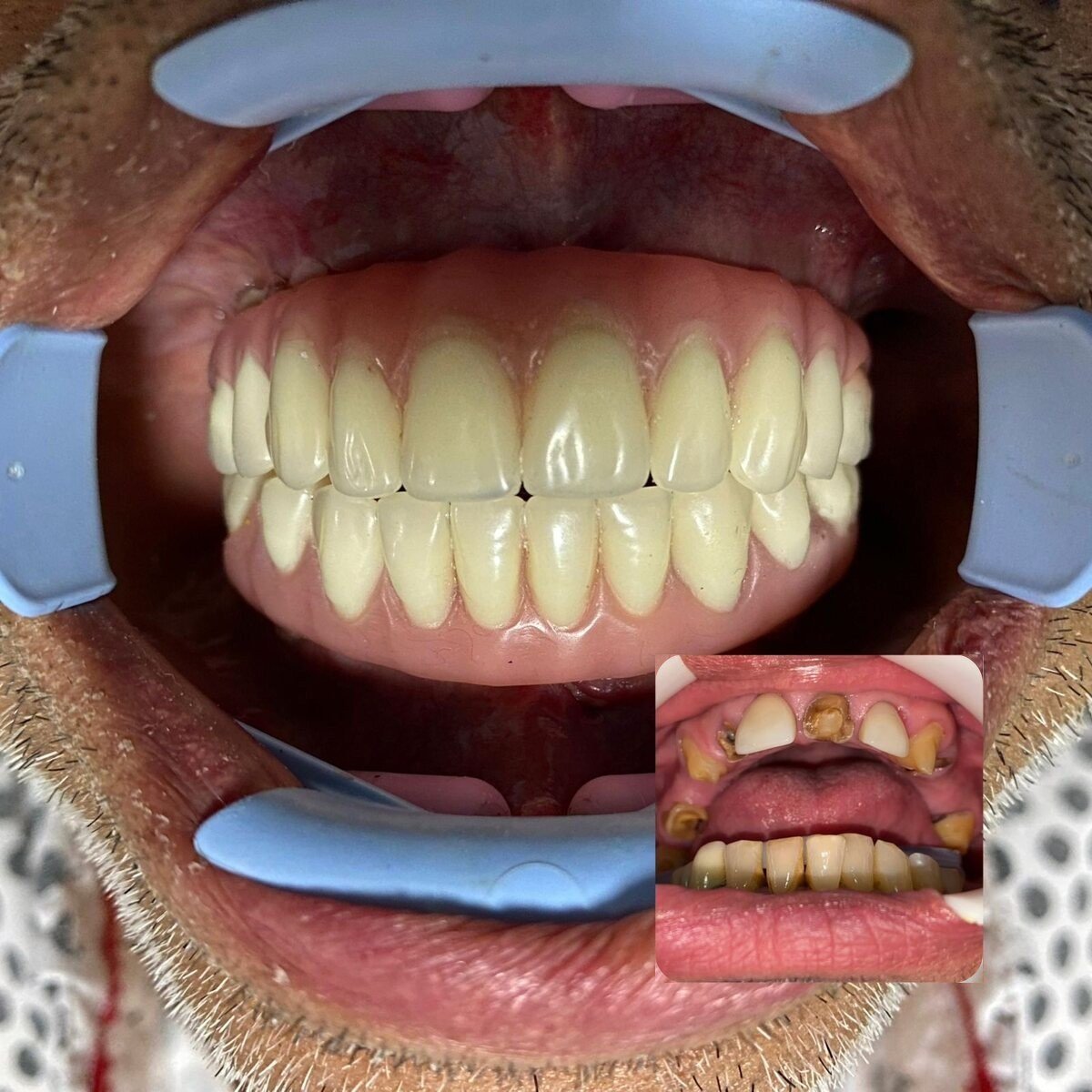 All-on-4 – worn and failing teeth replaced