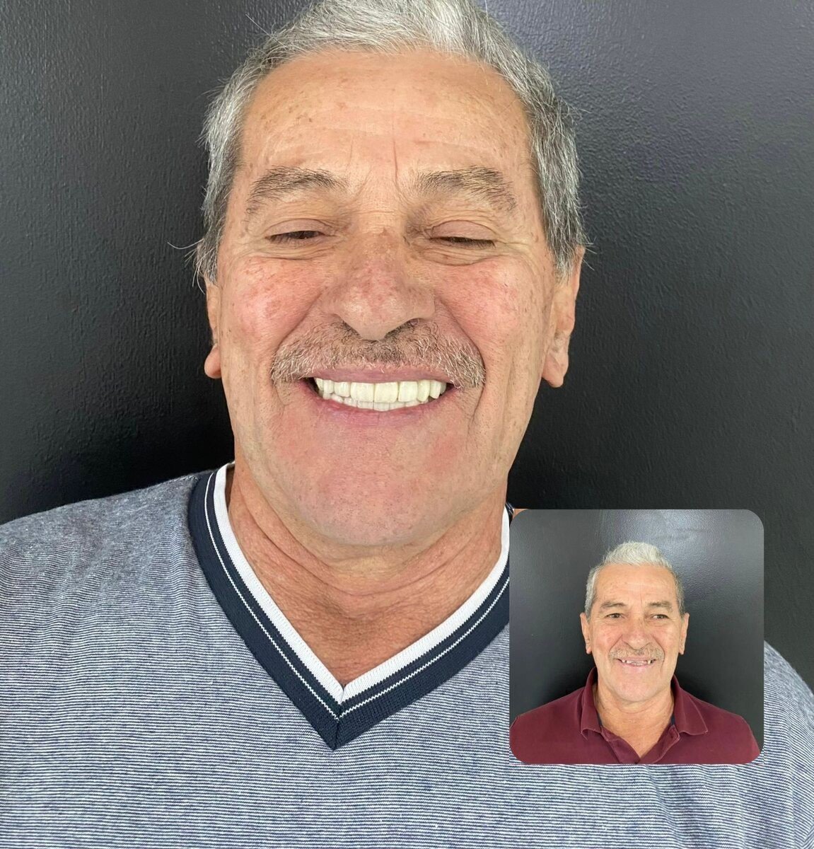 Full arch rebuilt on implants – patient of Dr. Erick Rivera, before and after