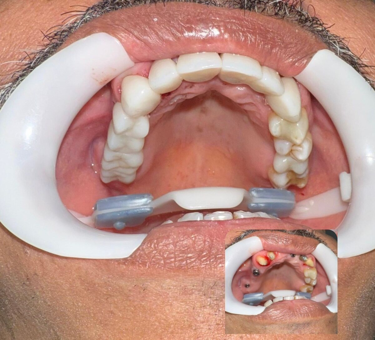Full-mouth reconstruction
