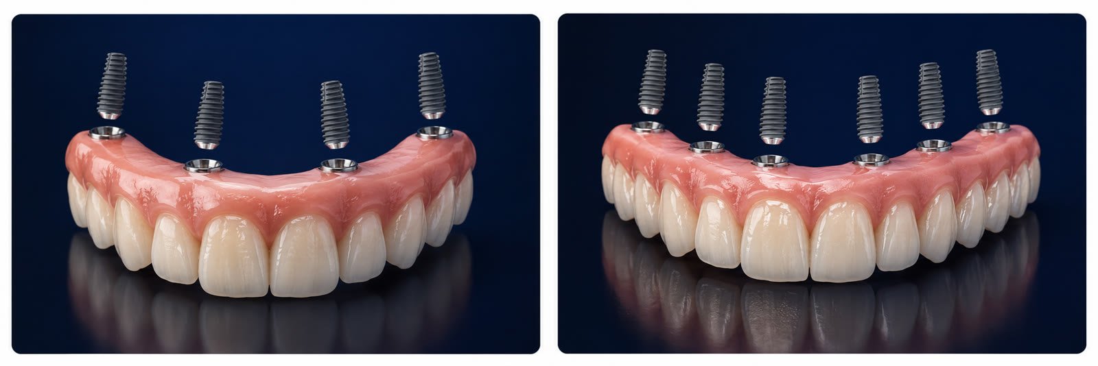 Full arch of fixed teeth carried on titanium implants